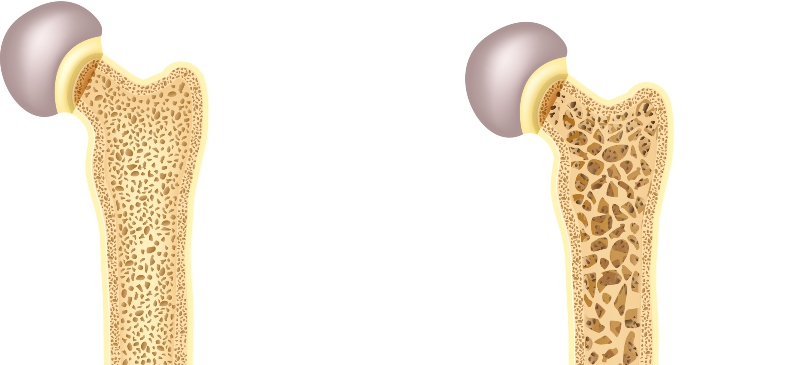 Ilustración del hueso de la cadera normal y el hueso con osteoporosis
