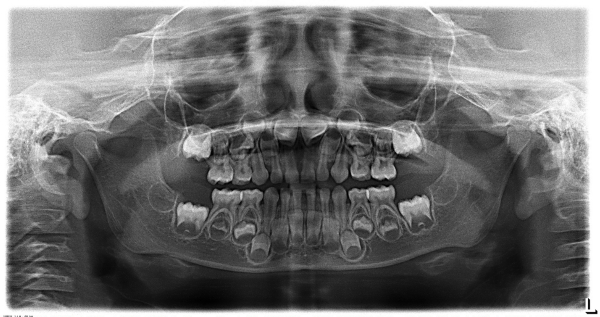 radiografía de la mandíbula de un adolescente menor de edad